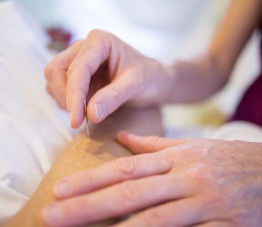 Acupuncture: 6 Reasons Why You Should Get It acupuncture, holistic healing, holistic